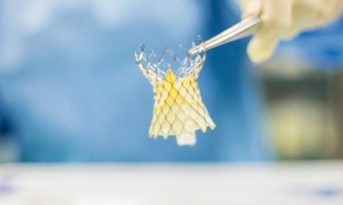 Heart Double Valve Replacement