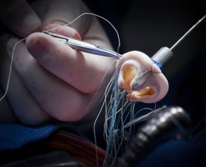 cardiac valve replacement
