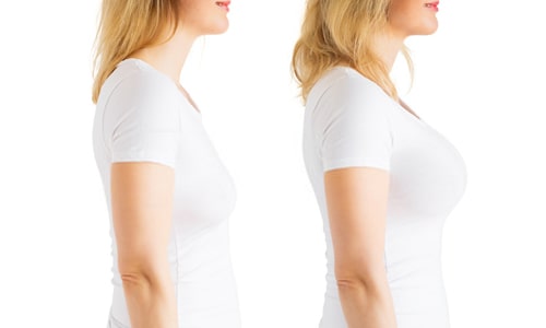 Breast Lift (Mastopexy)