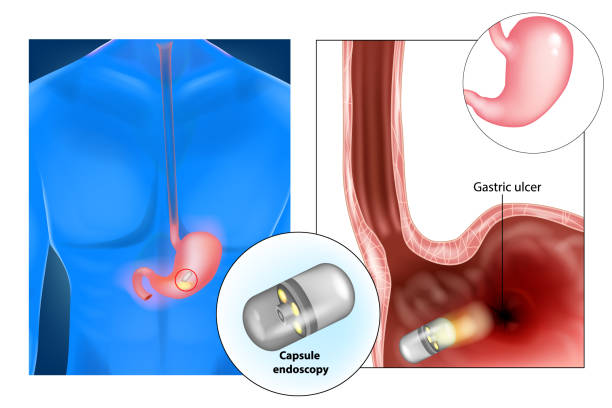 Capsule Endoscopy