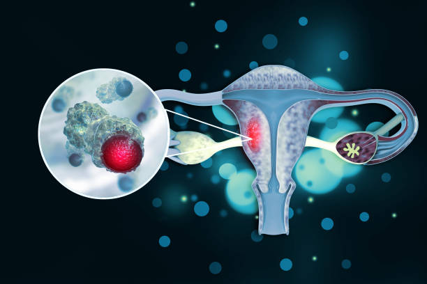 Cervical Cancer Treatment