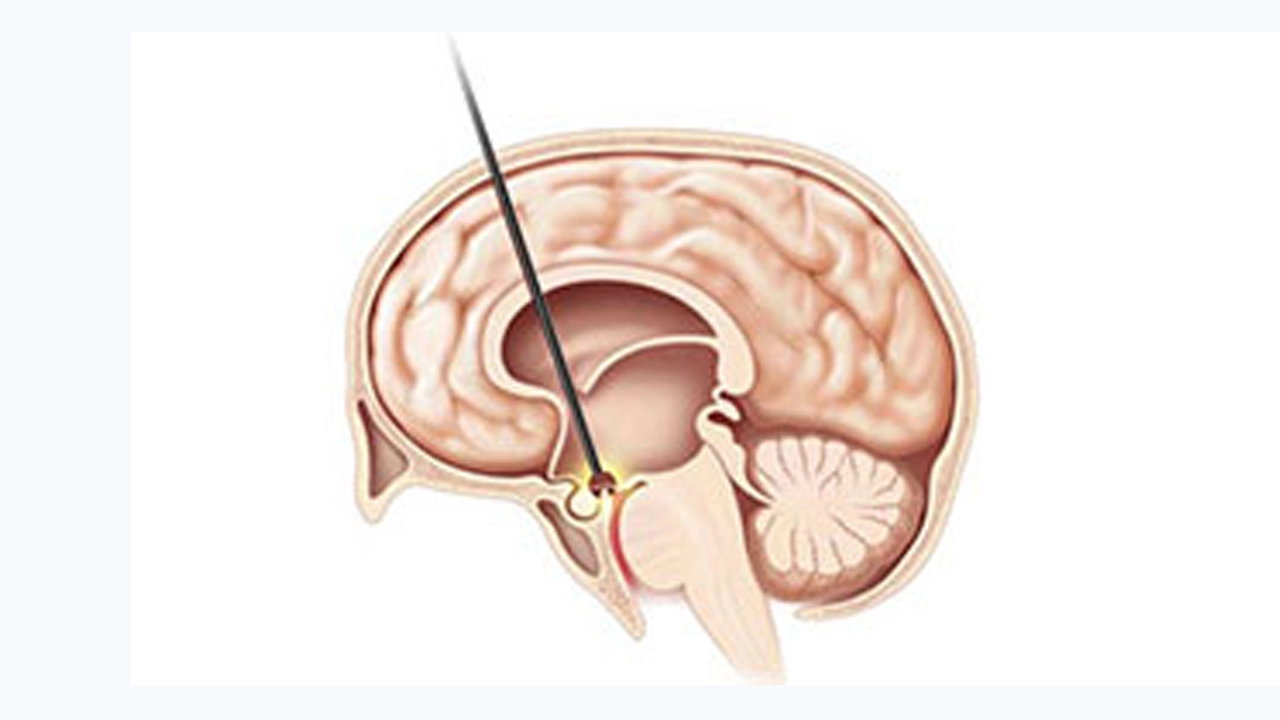 Endoscopic Third Ventriculostomy