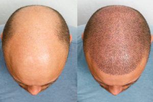 Hair Transplant
