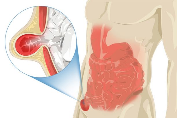 Inguinal Hernia Repair