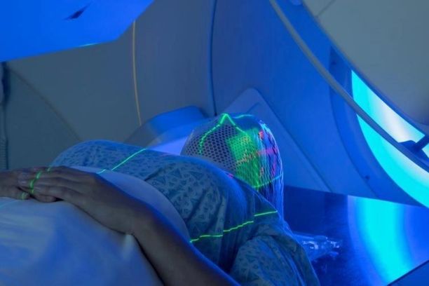 Intensity-modulated radiotherapy (IMRT)