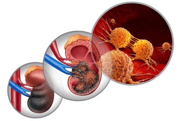 Kidney Cancer Treatment