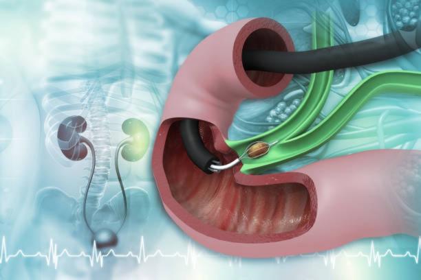 Kidney Stone Removal
