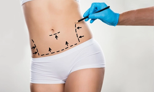 Liposuction