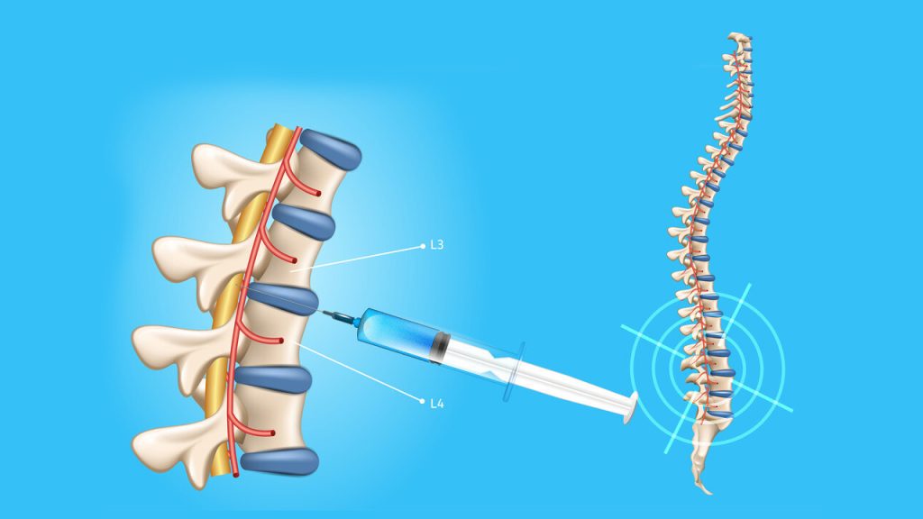 Lumbar Puncture