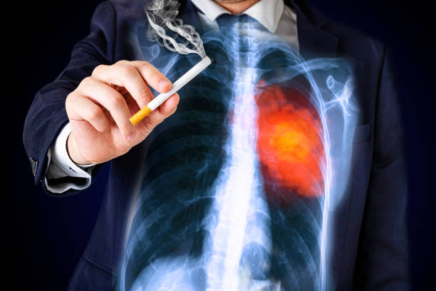 Lung Cancer Treatment