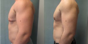 Male Breast Reduction
