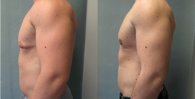 Male Breast Reduction
