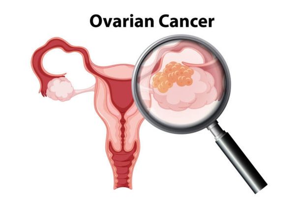 Ovarian Cancer Treatment
