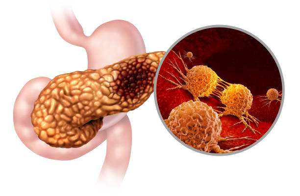 Pancreatic Cancer Treatment