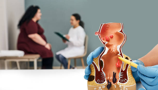 Rectal Polyp Removal