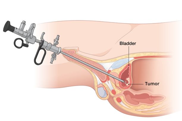 Trans Urethral Resection of Bladder Tumor (TURBT)