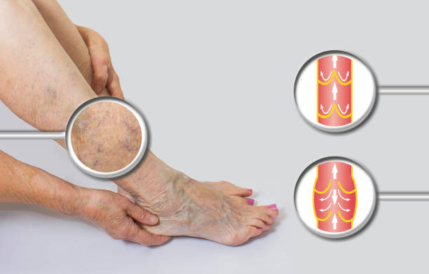 Varicose Vein Treatment