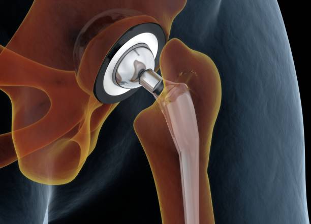 Hip Resurfacing Surgery