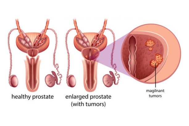 Prostate Cancer Treatment