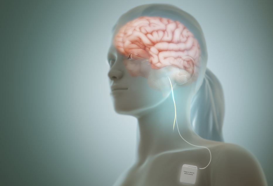 Vagal Nerve Stimulator for Epilepsy