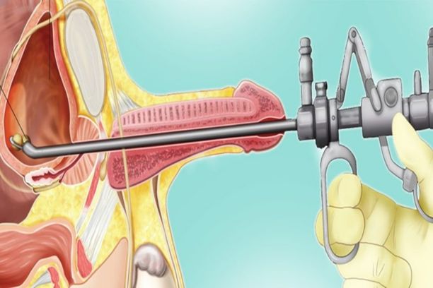 Trans Urethral Resection of Prostrate (TURP)