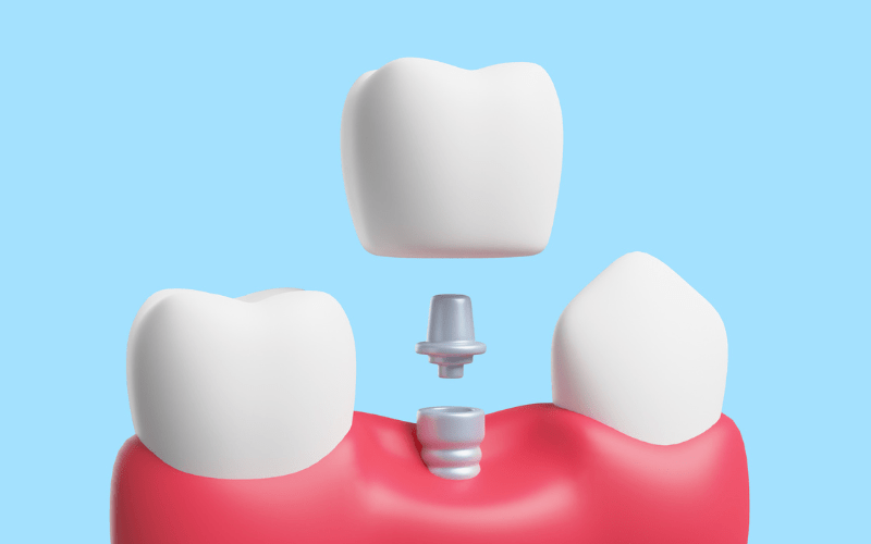 Dental Crowns Treatment