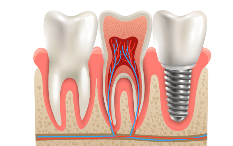 Dental Implant Treatment