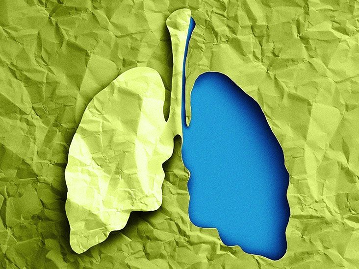 How quickly does lung cancer spread? Your FAQ