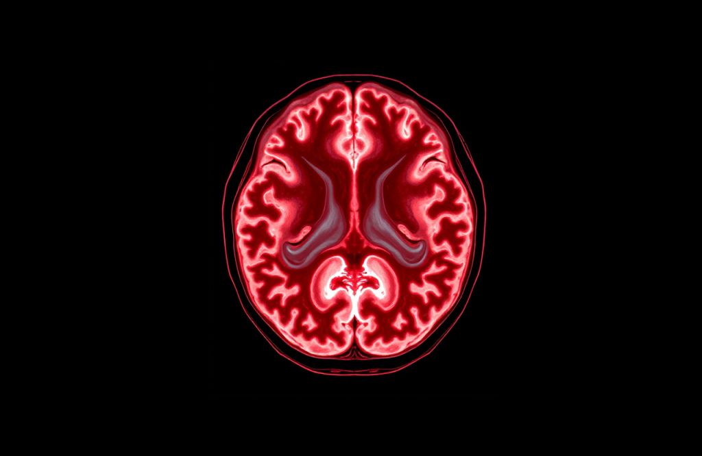 MRI Insights: Predicting Depression Treatment Outcomes for Better Mental Health