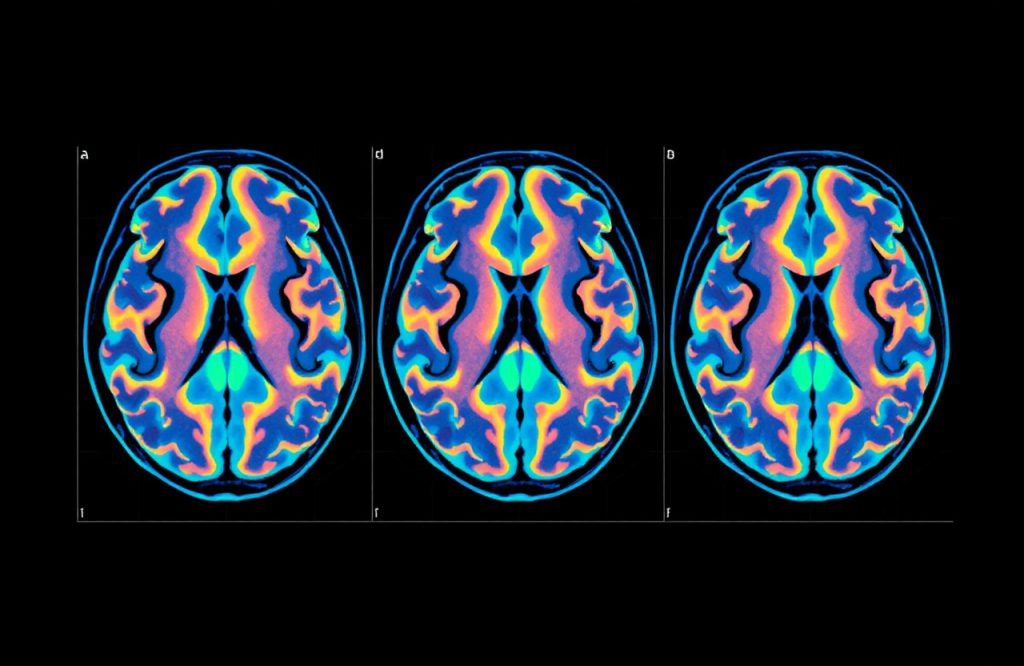 Evaluating the Reliability of fMRI in Monitoring Alzheimer’s Treatment Progress