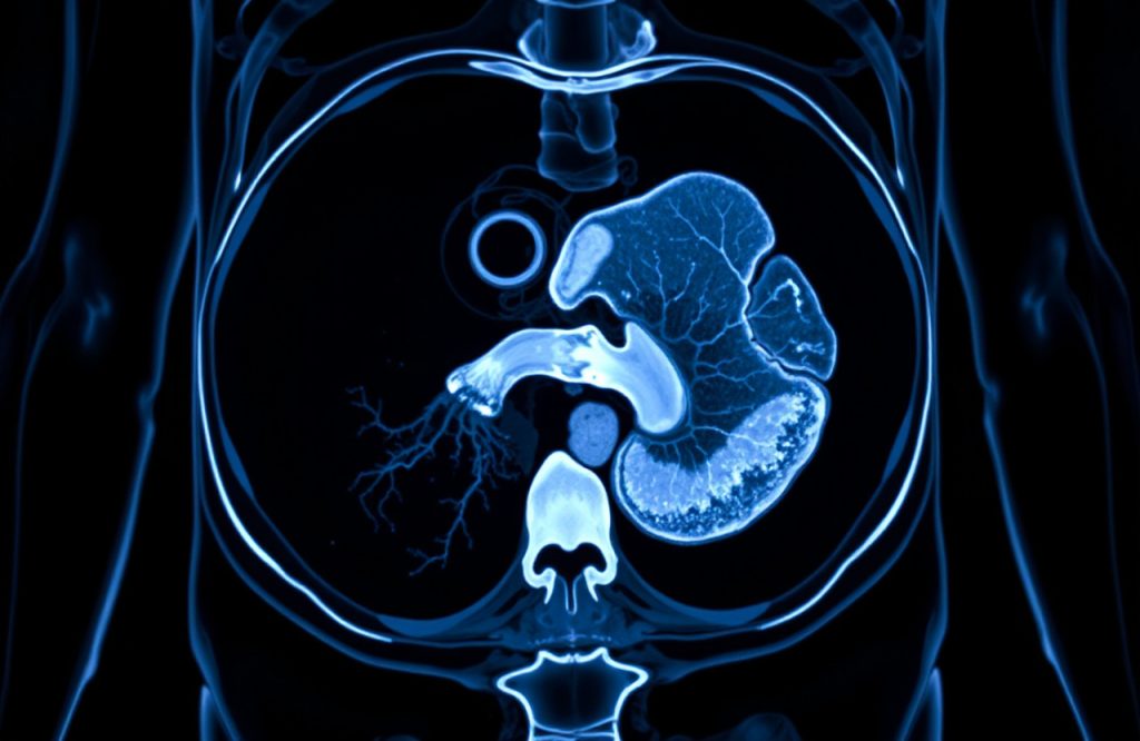 Abdominal Aortic Aneurysm Screening in Sweden: Weighing the Harms Against the Benefits