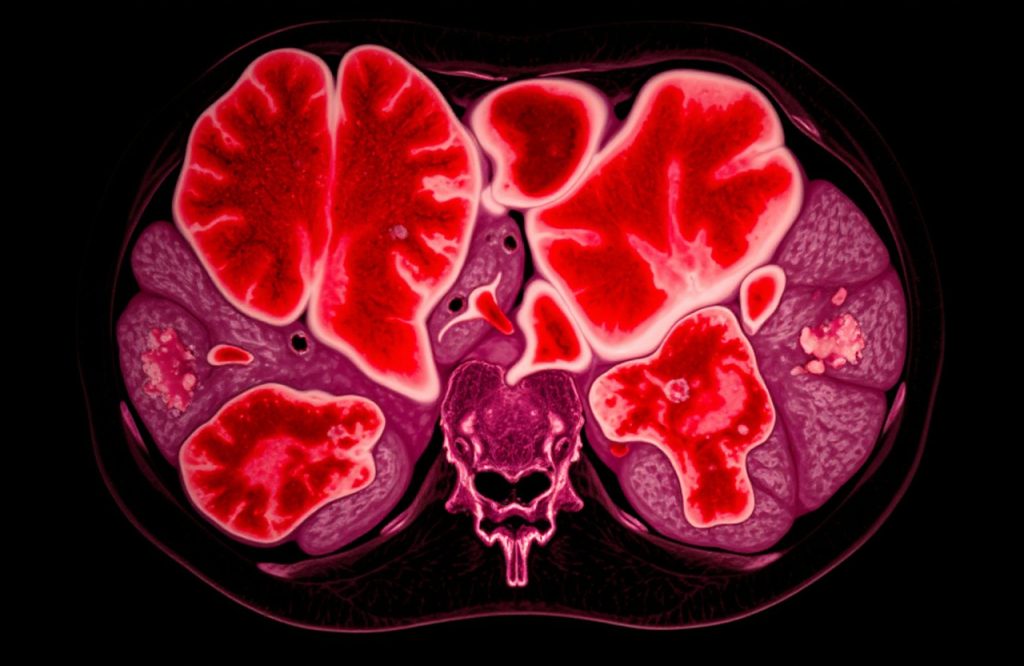 Conquering Ductal Carcinoma In Situ: Your Guide to Effective Treatment and Prevention