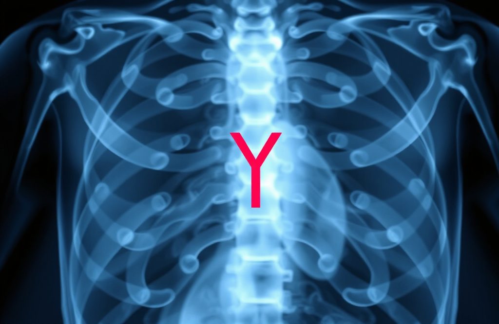 Y Chromosome Loss Linked to Increased Cardiovascular Disease Risk in New Study